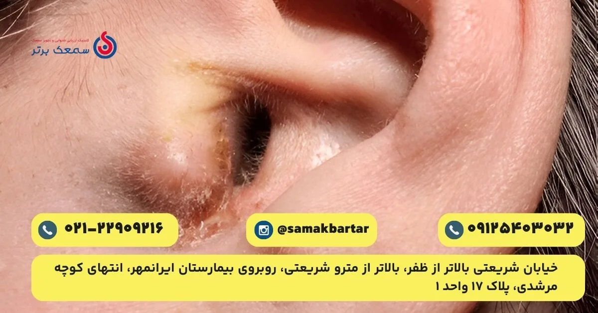 عکس قارچ گوش عفونت قارچی گوش عکس قارچ گوش