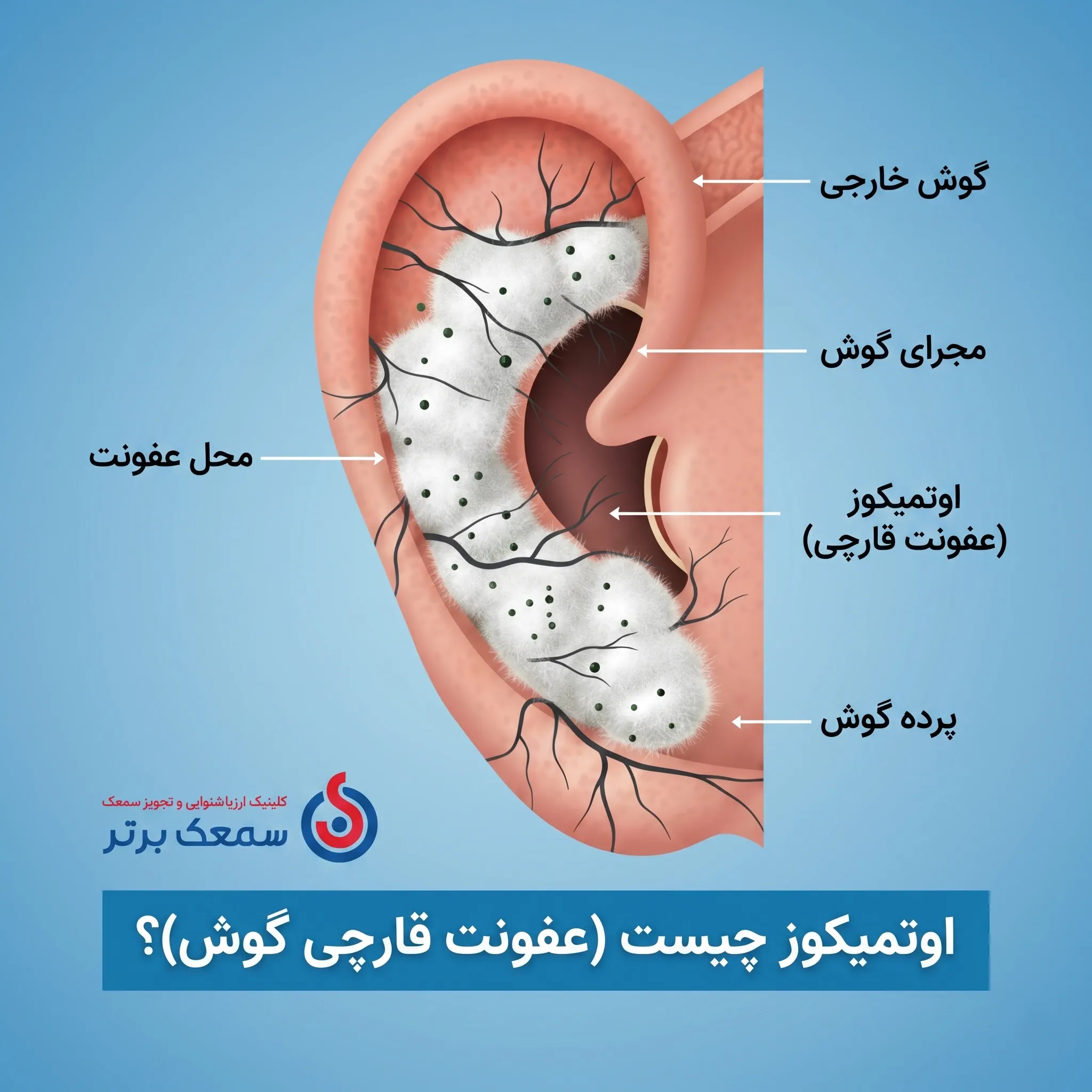 اوتمیکوز یا عفونت قارچی - عکس قارچ گوش عفونت قارچی گوش اوتمیکوز یا عفونت قارچی - عکس قارچ گوش