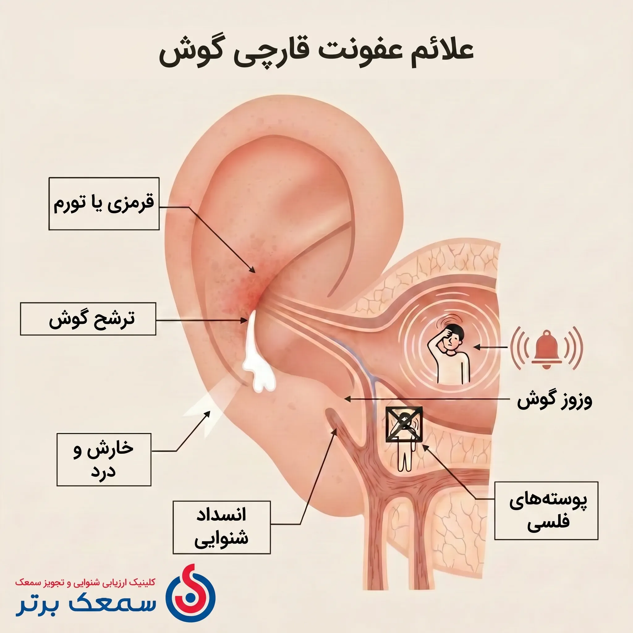 علائم عفونت قارچ گوش - عکس قارچ گوش عفونت قارچی گوش علائم عفونت قارچ گوش - عکس قارچ گوش