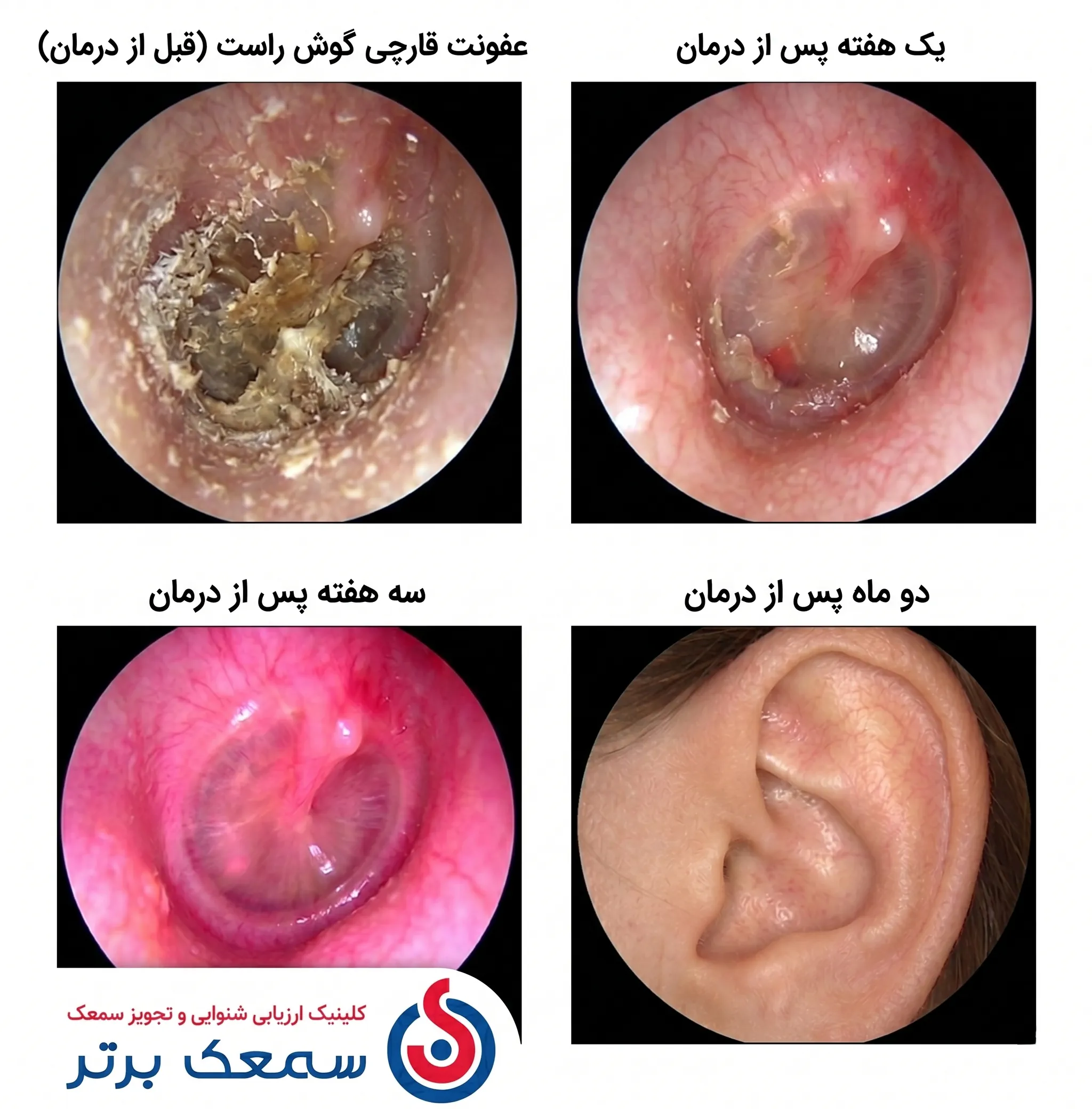مراحل قارچ گوش - عکس قارچ گوش عفونت قارچی گوش مراحل قارچ گوش - عکس قارچ گوش